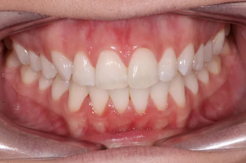 After Invisalign Invisalign results