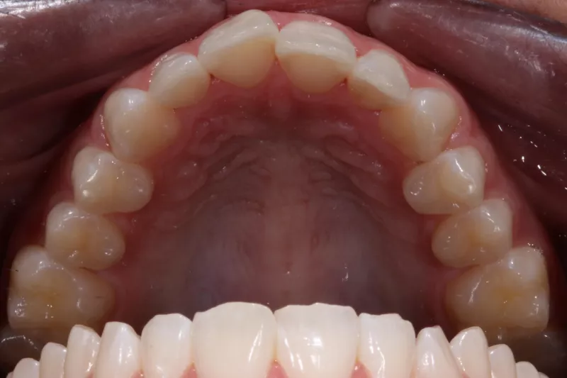 Before Invisalign Before Invisalign