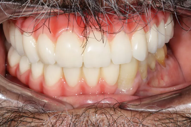 All on x dental implants