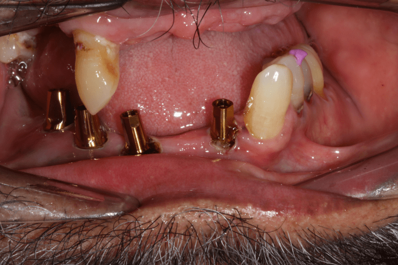 All on x dental implants