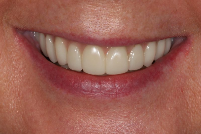 Dental implants after