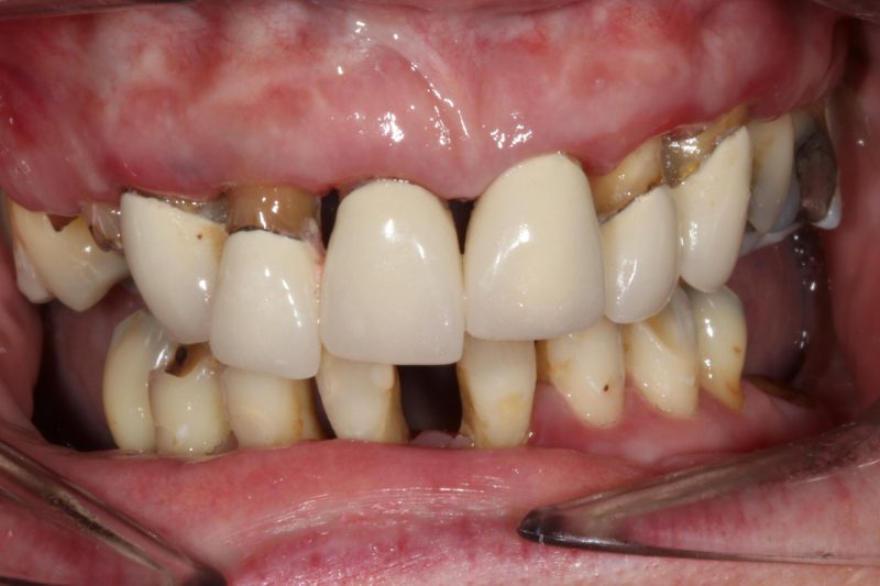 Before dental implants