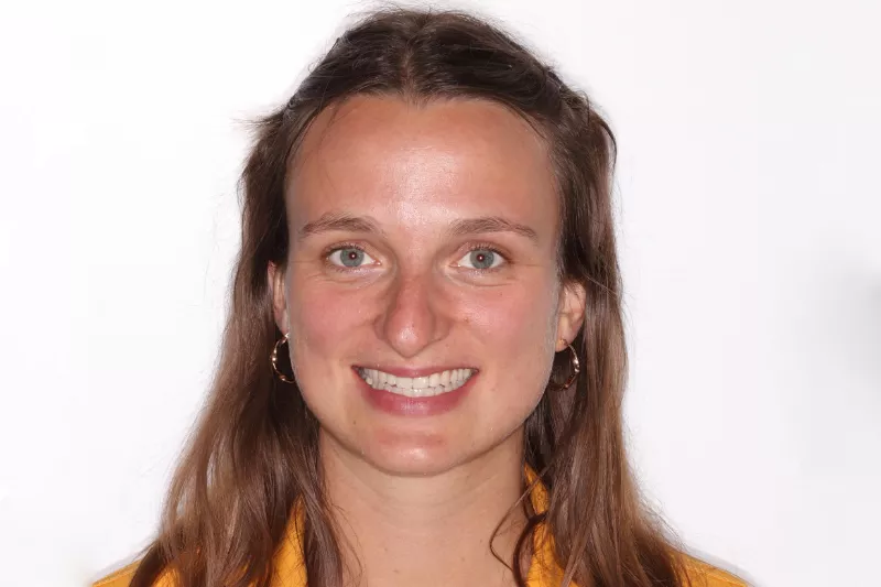 After Invisalign After Invisalign treatment