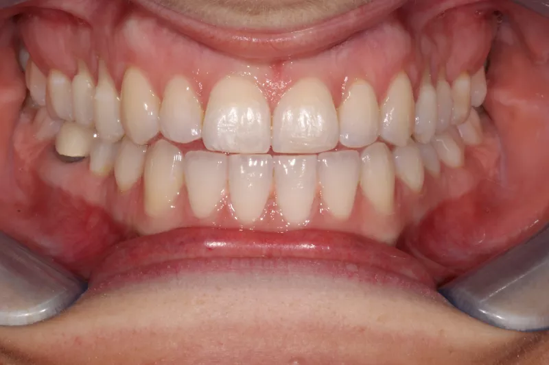 After Invisalign After Invisalign treatment
