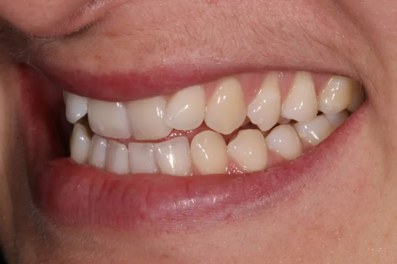 Before Invisalign Before Invisalign
