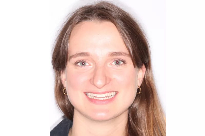 Before Invisalign Before Invisalign