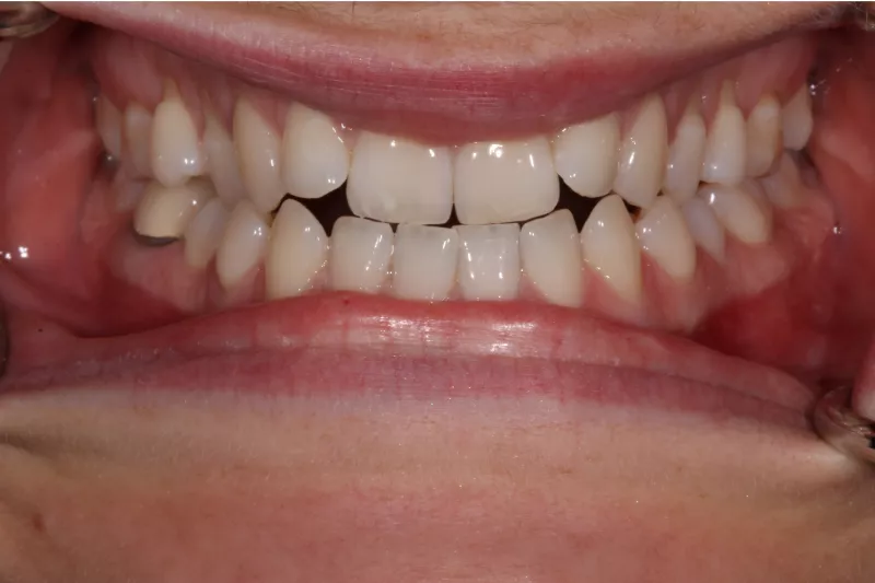 Before Invisalign Before Invisalign