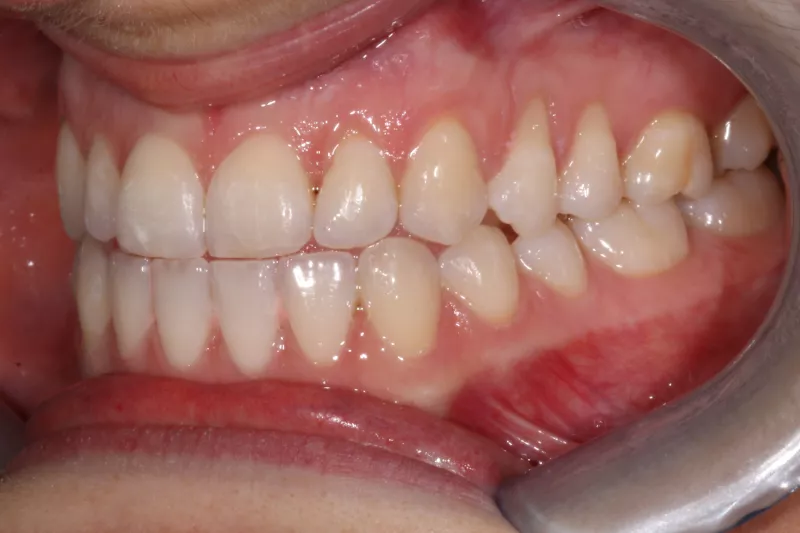 After Invisalign After Invisalign treatment