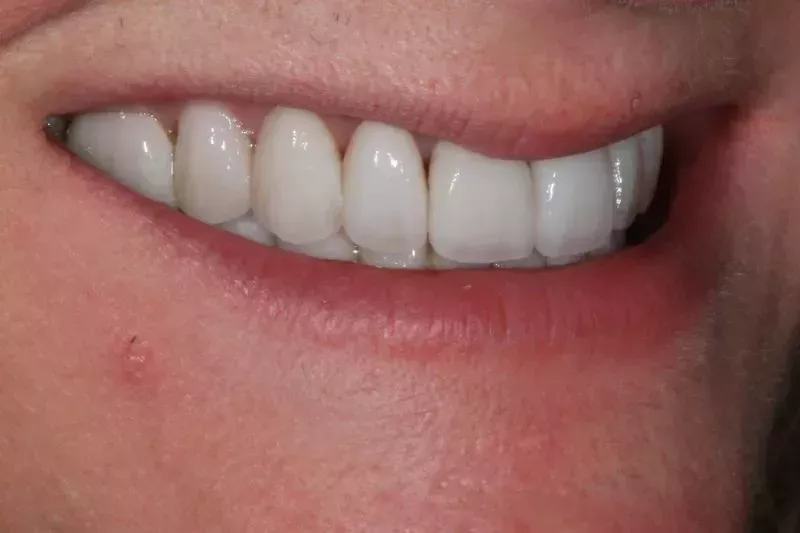 Smile design by Dr Aleem