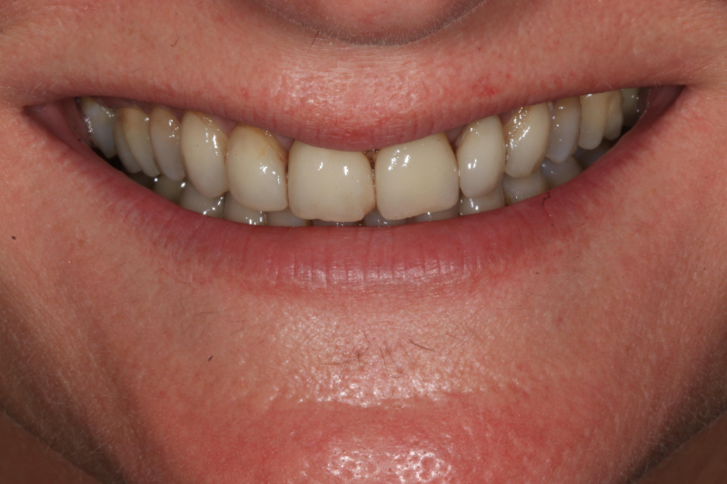 Before smile design with veneers