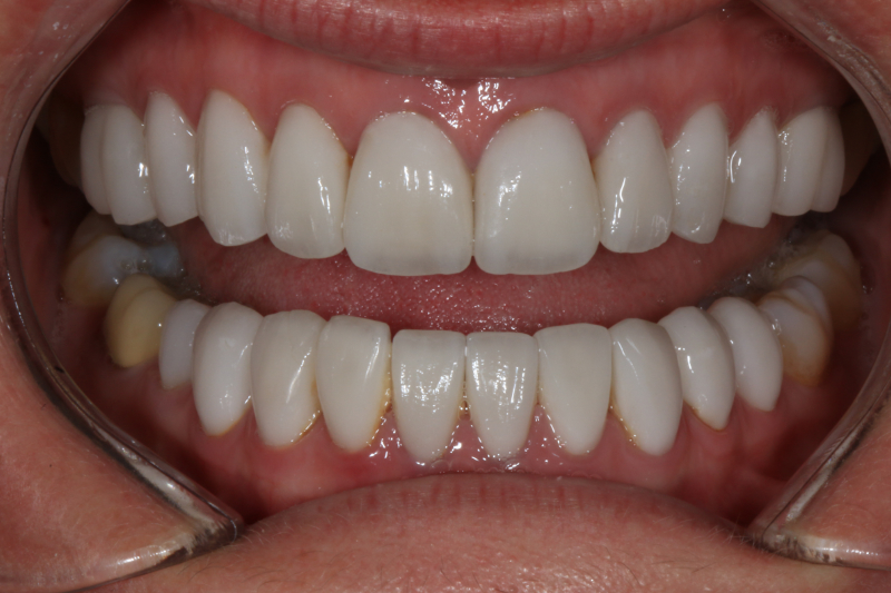 Full mouth veneers