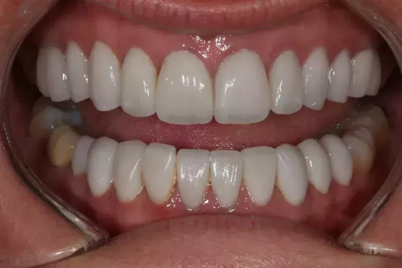 Full mouth veneers