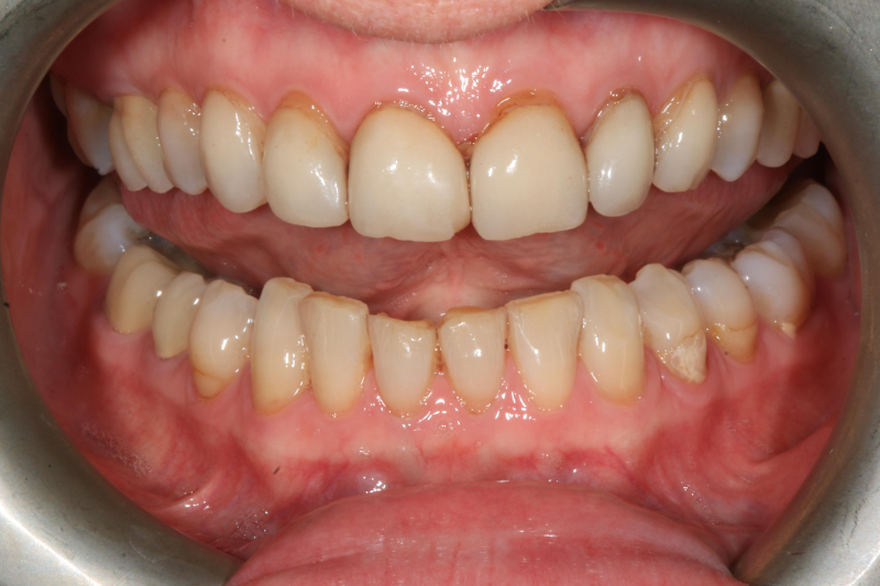 Before full mouth veneers