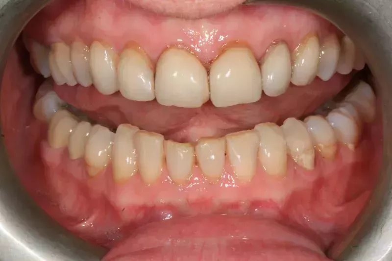 Before full mouth veneers