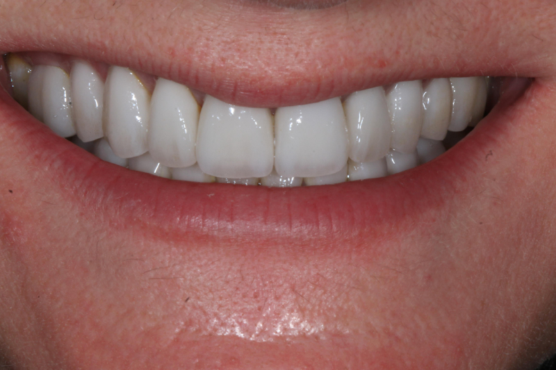 Close up smile design