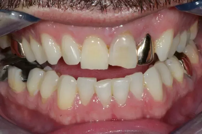 Broken teeth veneers