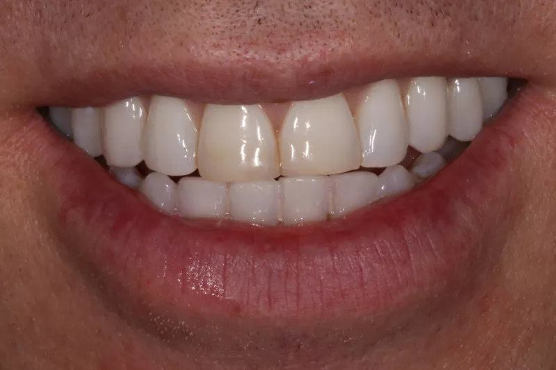 After Invisalign After Invisalign