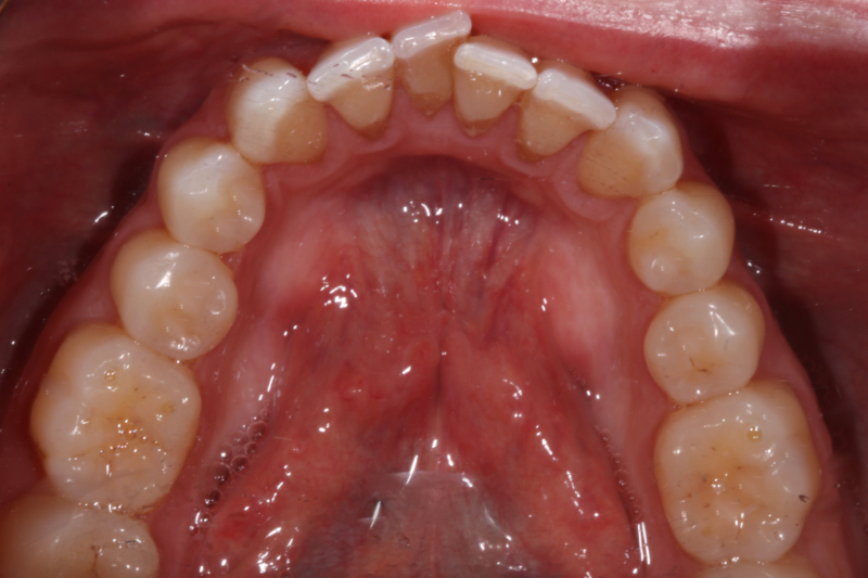 Crowded teeth Invisalign