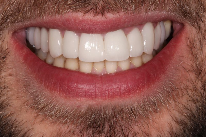 Full arch veneers