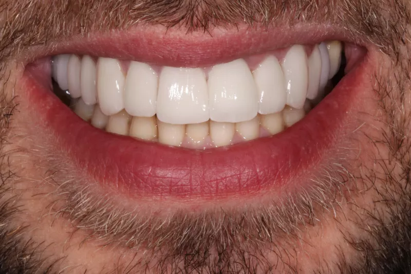 Full arch veneers