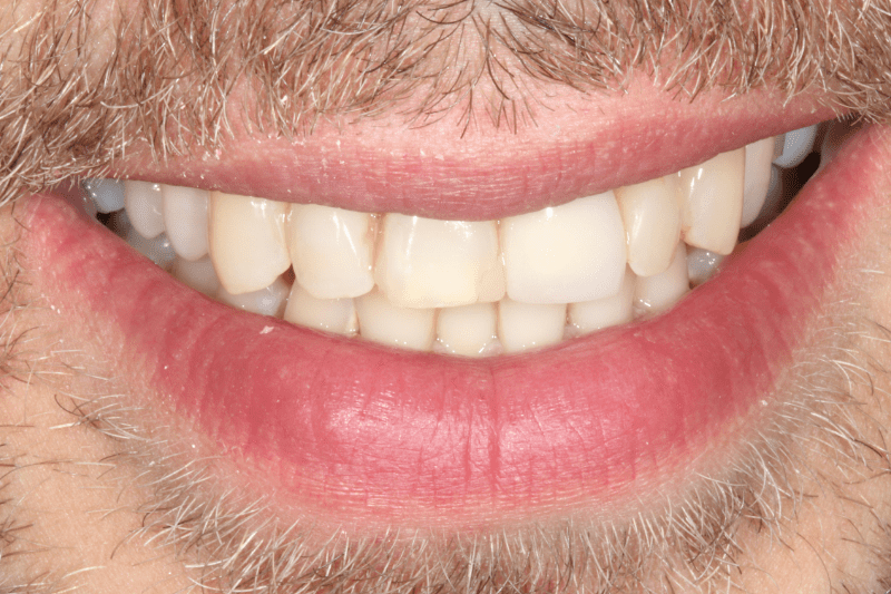 Before porcelain veneers