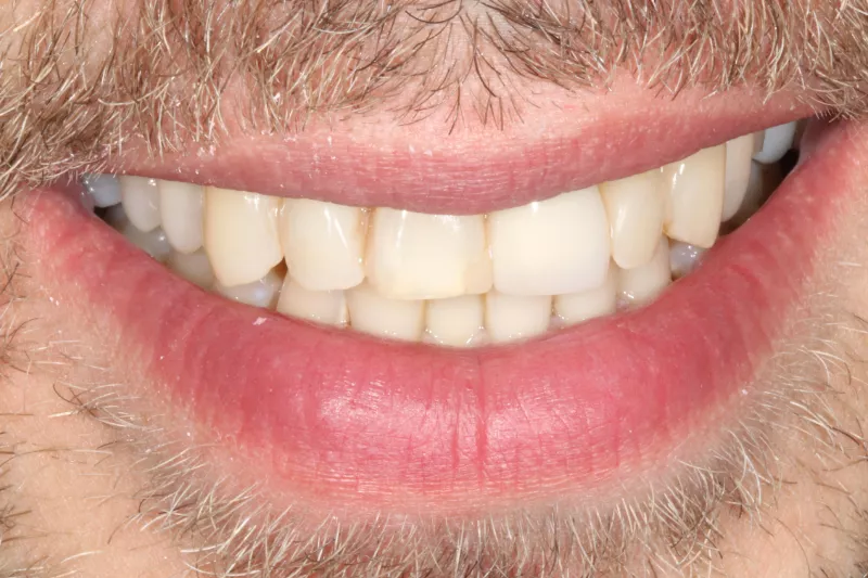 Before porcelain veneers