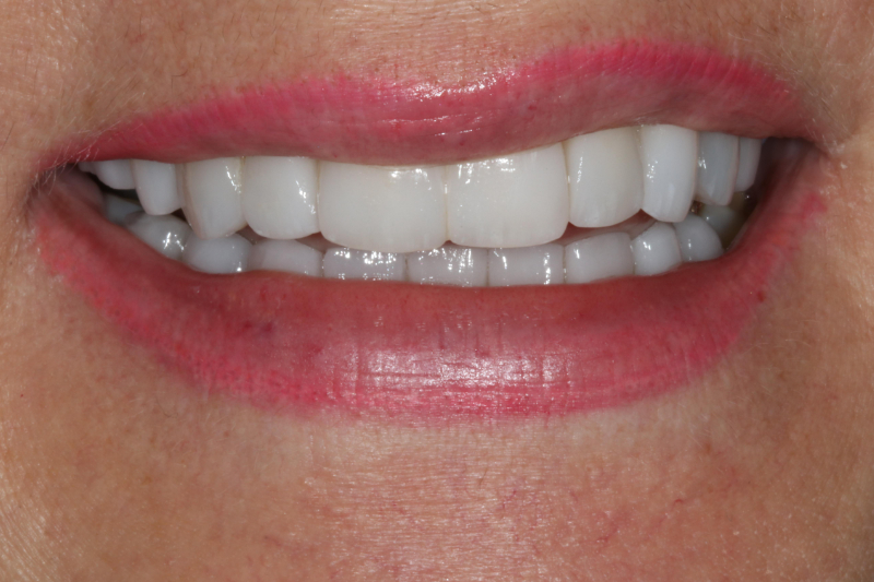 Porcelain Veneers