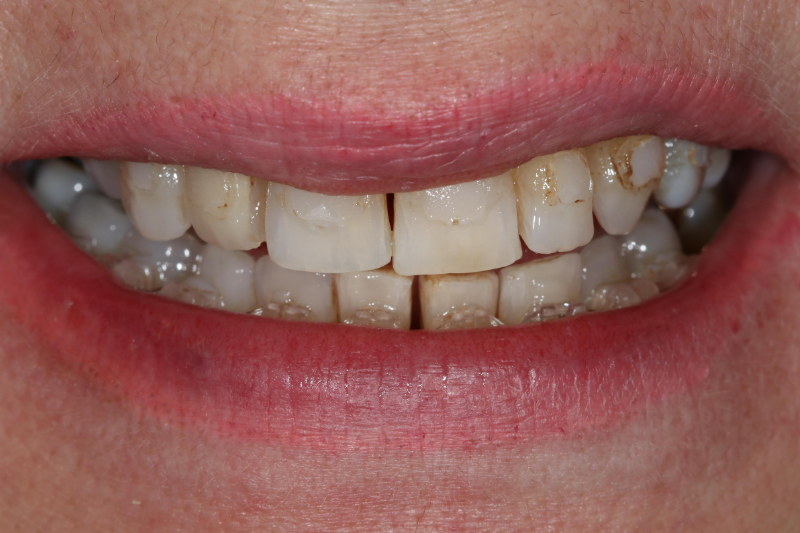 Porcelain Veneers