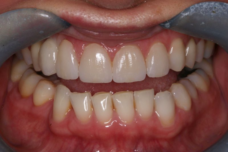 one dental implant