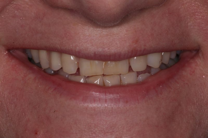 Before dental implant