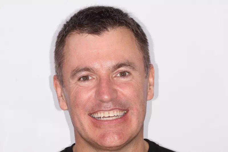 Fixed Braces after Fixed Braces after