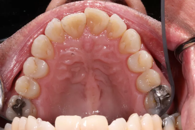 Before Fixed Braces Before Fixed Braces