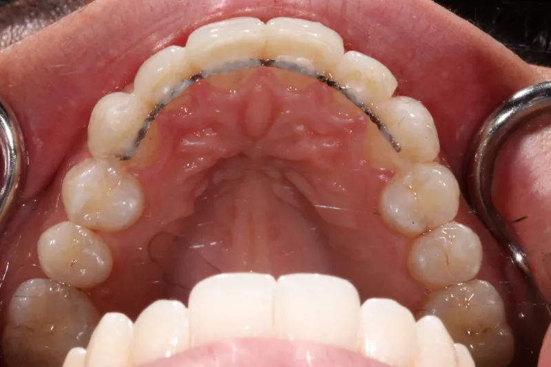 After Invisalign After Invisalign fixed retainer