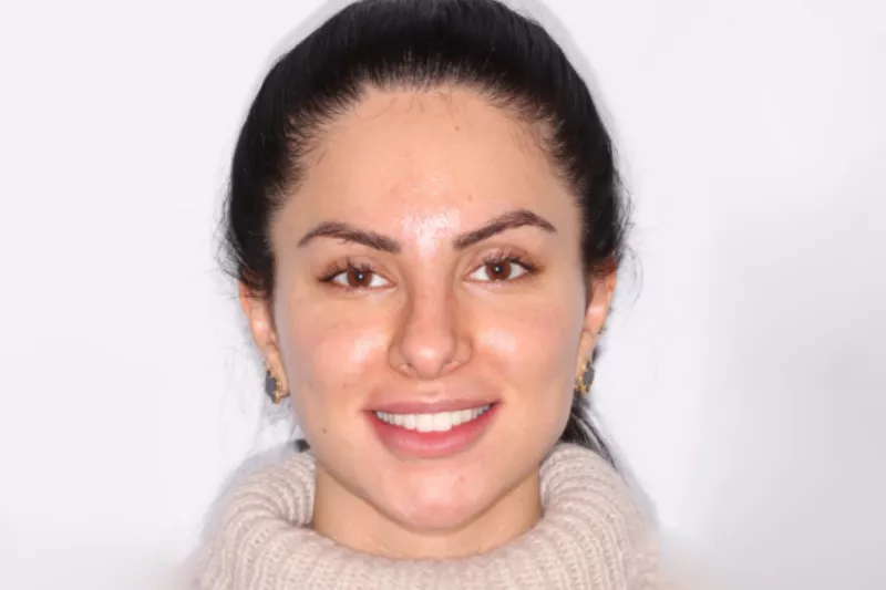 After Invisalign Invisalign Results TKC Dental