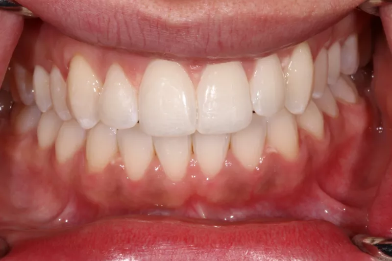 After Invisalign After Invisalign