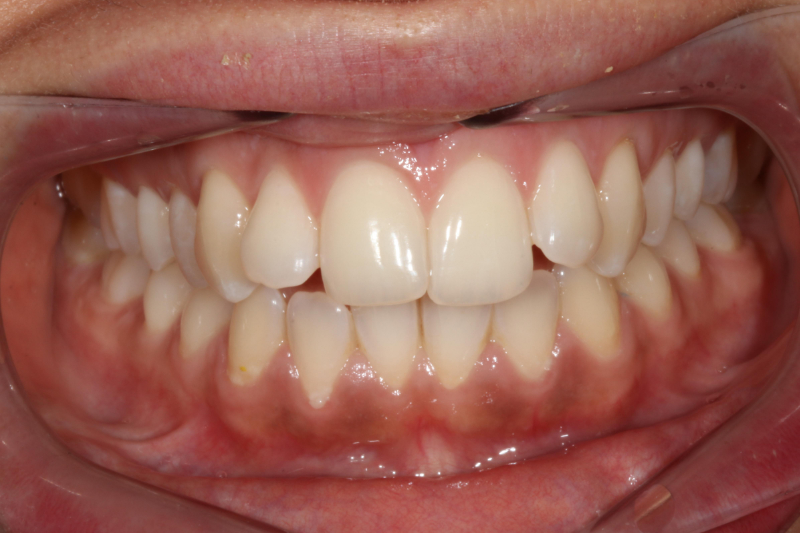 Misaligned teeth Invisalign