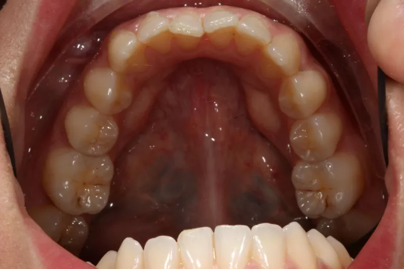 Crowding invisalign Crowding invisalign