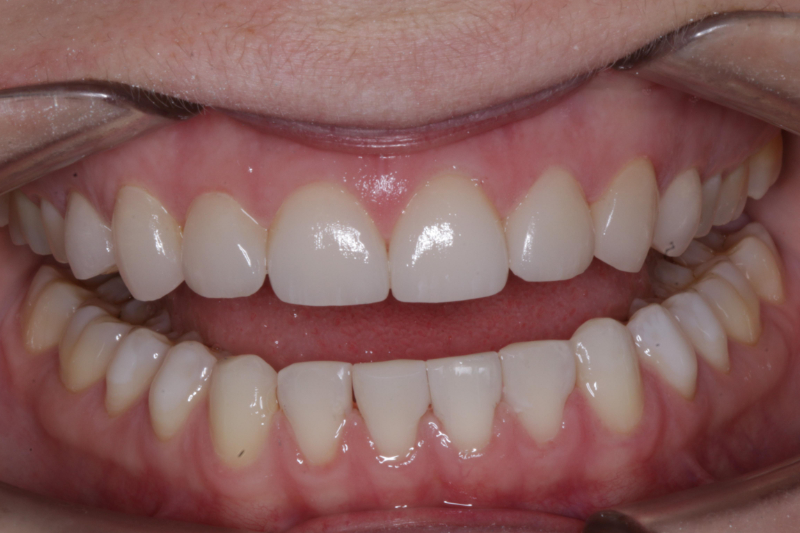 10 natural looking veneers