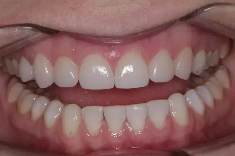 10 natural looking veneers