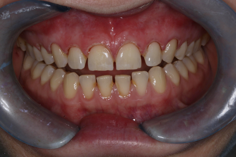 Before 10 veneers no cutting