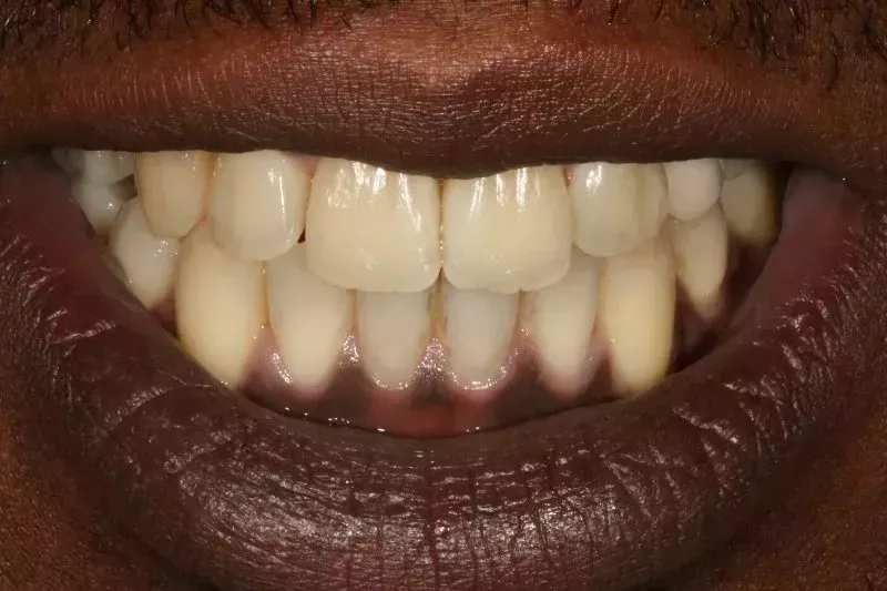 Fixed braces results