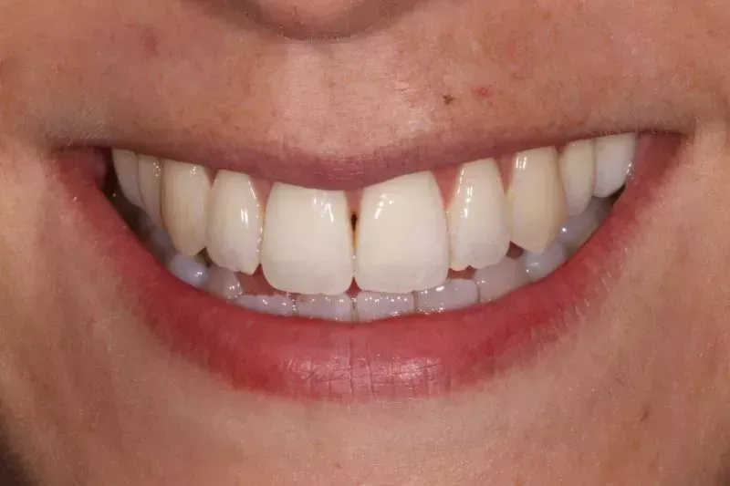 Fixed braces teeth straightening