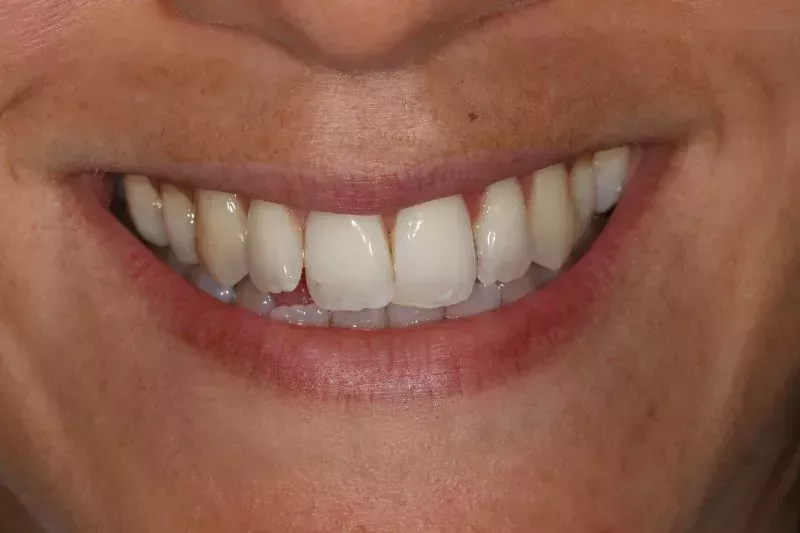 Fixed braces teeth straightening