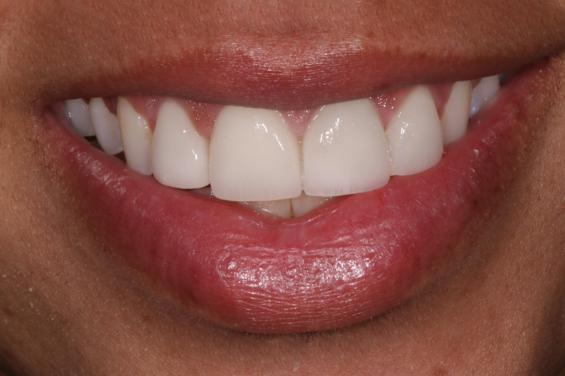 Close up of dental veneers