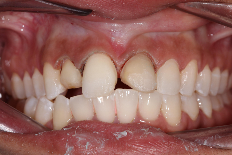 Fixing short and crooked teeth