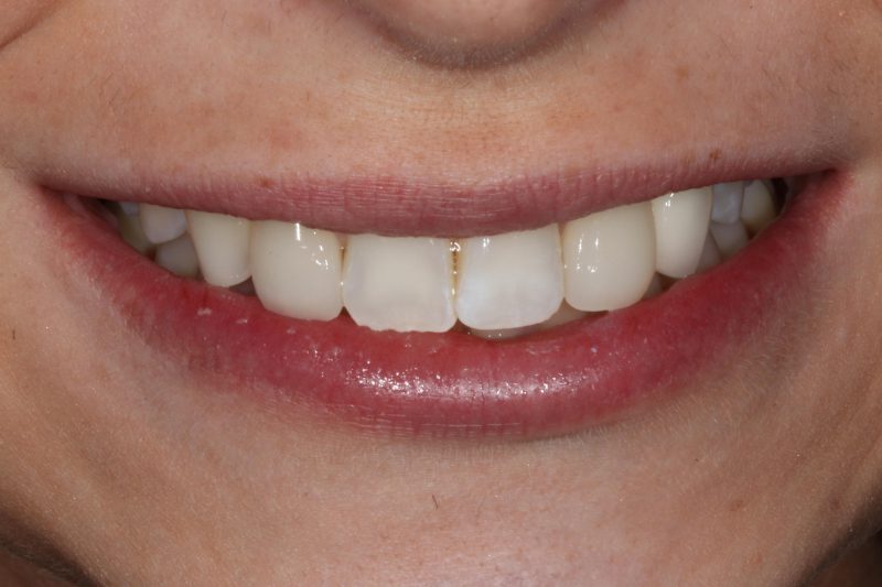 Single implant after