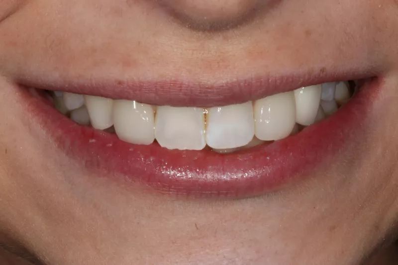 Single implant after