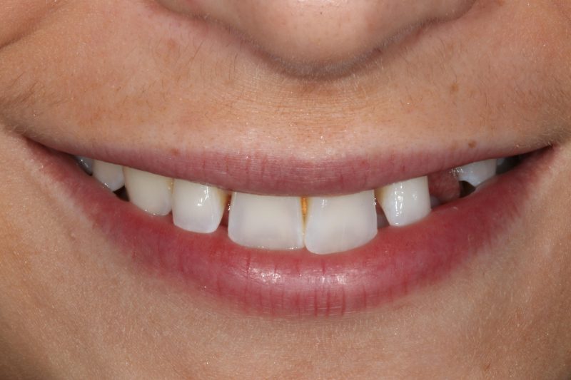 Before dental implant