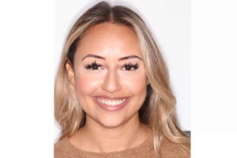 Gum contour with waterlase laser