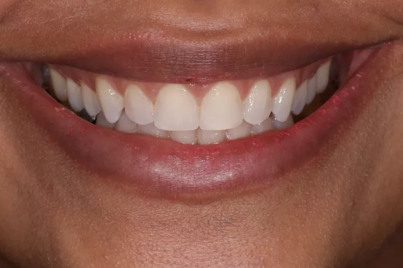 Gum contour and composite bonding